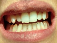 Estetska stomatologija-prije 7