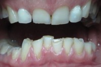 Estetska stomatologija-prije 5