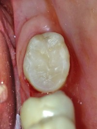 Bolesti zuba 15