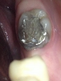 Bolesti zuba 14