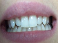 Estetska stomatologija-poslije 7