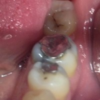 Bolesti zuba 11