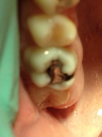 Bolesti zuba 10