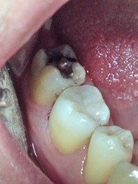 Bolesti zuba 9