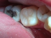 Bolesti zuba 12