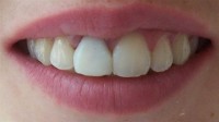 Estetska stomatologija-prije 3