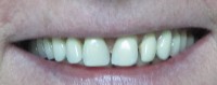 Estetska stomatologija-prije 6